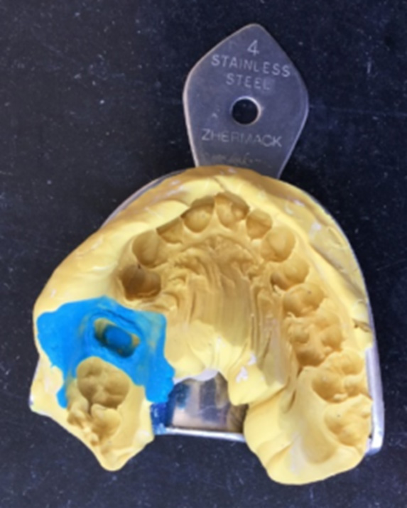 Impression taken with a metal tray that is too small and an exceeded working time, which is responsible for a poor bond between the materials. Long flow defects are visible in the palatal area.